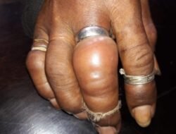 Sepanjang 2025 Damkar Ambon Tangani 42 Kasus Cincin yang Terjebak